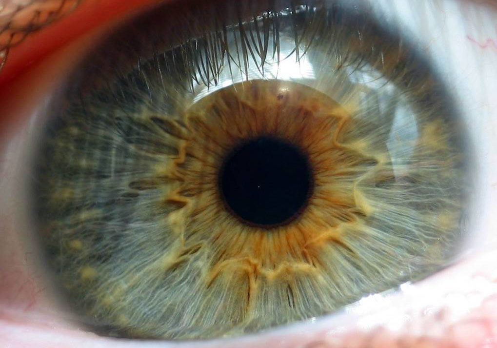 Дистрофия роговицы глаза