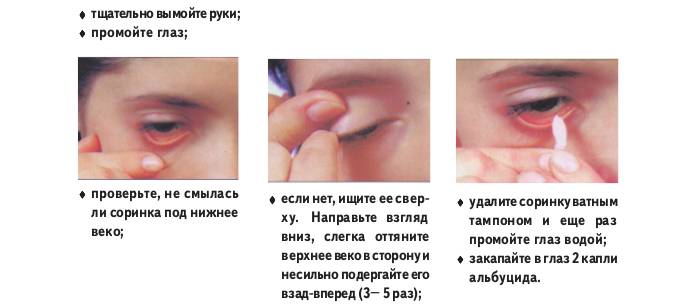 Что делать, если в глаз попала соринка