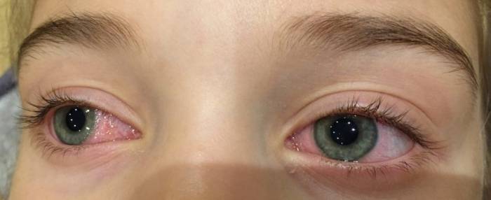 Лечение конъюнктивита у ребенка в 3 года