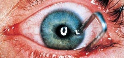 Что делать при травме глаза