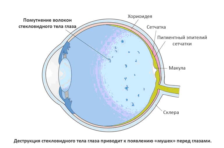 Плавающие помутнения в стекловидном теле