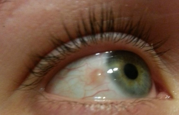 Симптомы пингвекулы