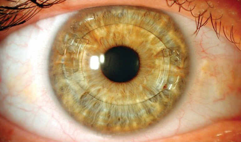 Показания к имплантации