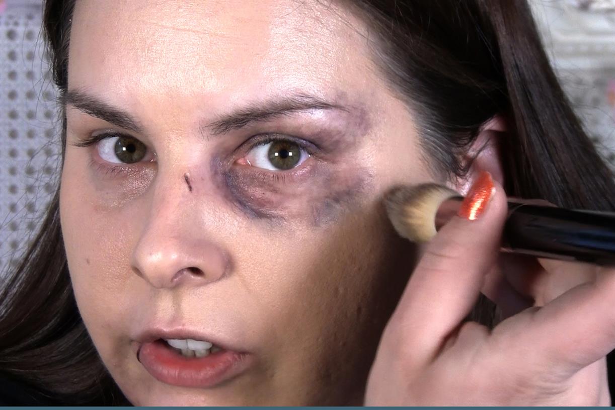 Как долго проходит синяк под глазом - через какое время он исчезает