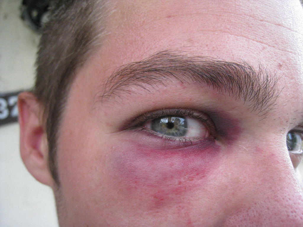 Как долго проходит синяк под глазом - через какое время он исчезает