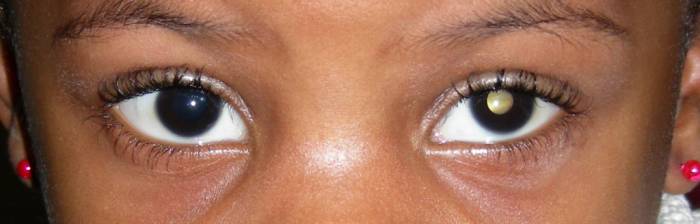 Ретинобластома - рак сетчатки глаза