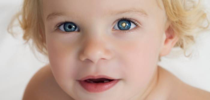 Ретинобластома - рак сетчатки глаза