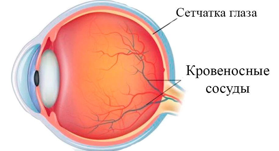 сетчатка при гипертонии