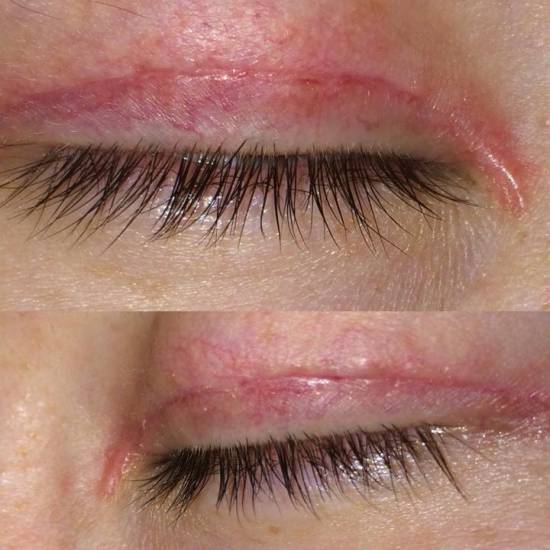 Швы после блефаропластики