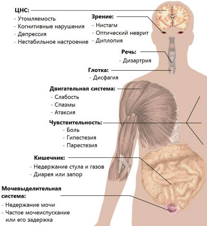 Рассеянный склероз и зрение