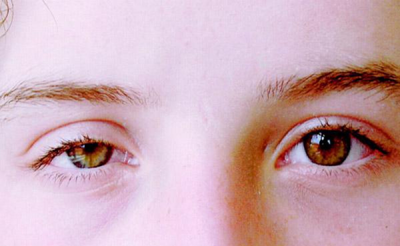 Синдром Горнера