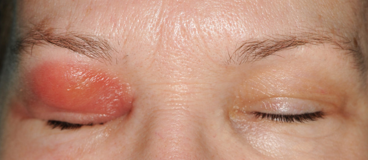 Что такое флегмона глазницы