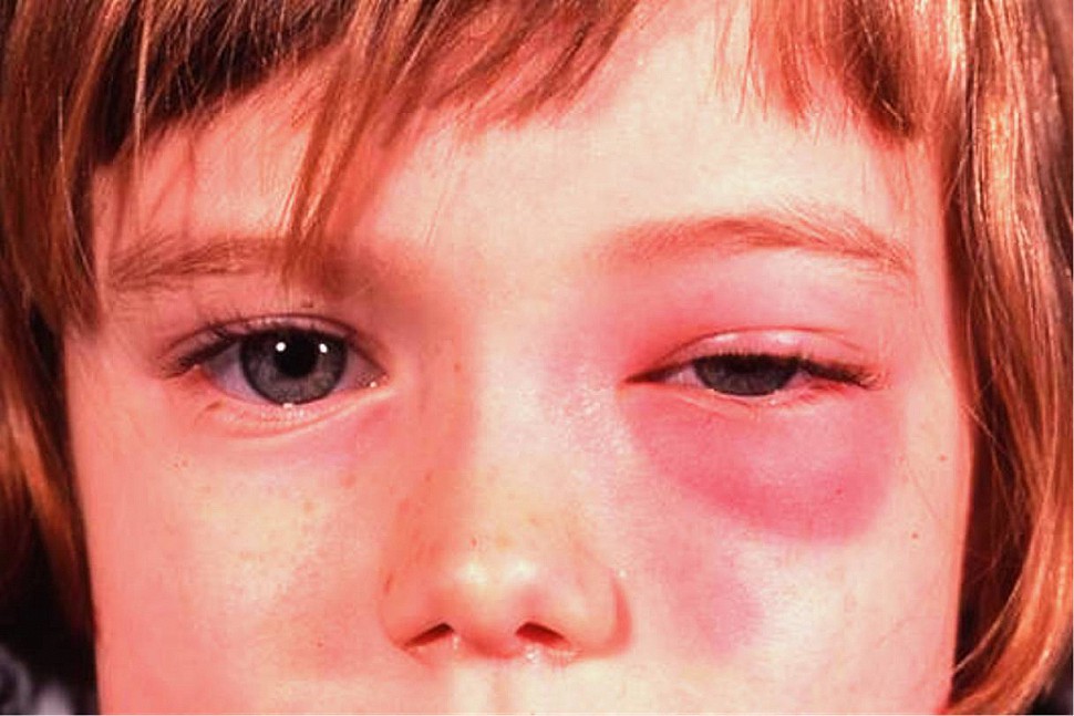 Что делать при воспалении глаз