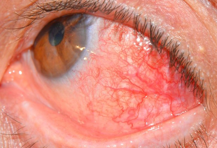 Повреждение роговицы глаза