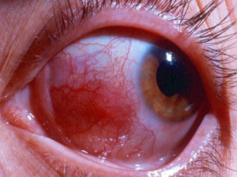 Боязнь света - признак какого заболевания