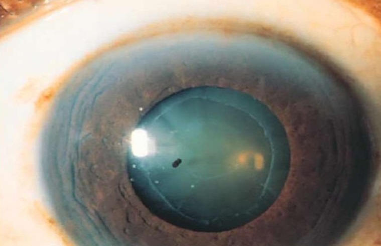 Открытоугольная и закрытоугольная глаукома