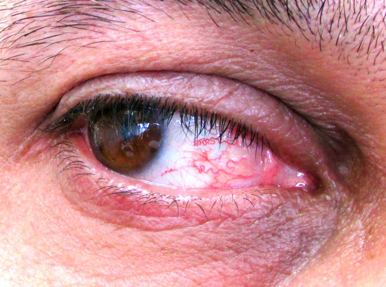 Болезнь Шегрена