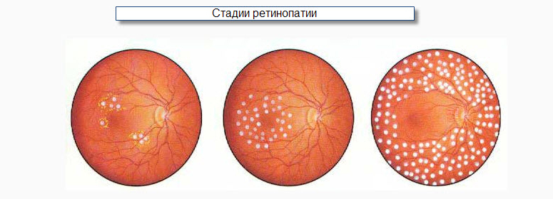 Диабетическая ретинопатия