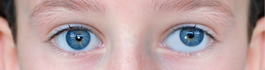 Как проверить косоглазие