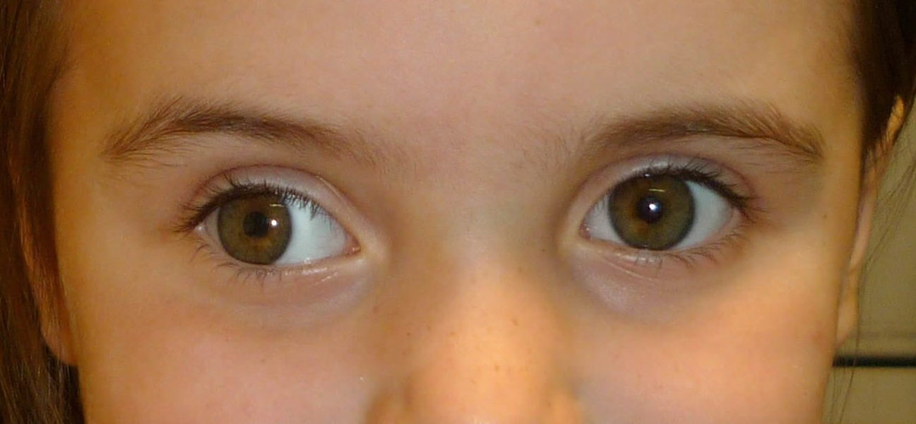 Паралитическое косоглазие