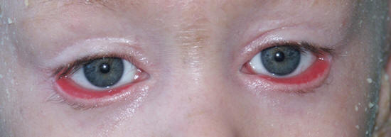 Осложнения