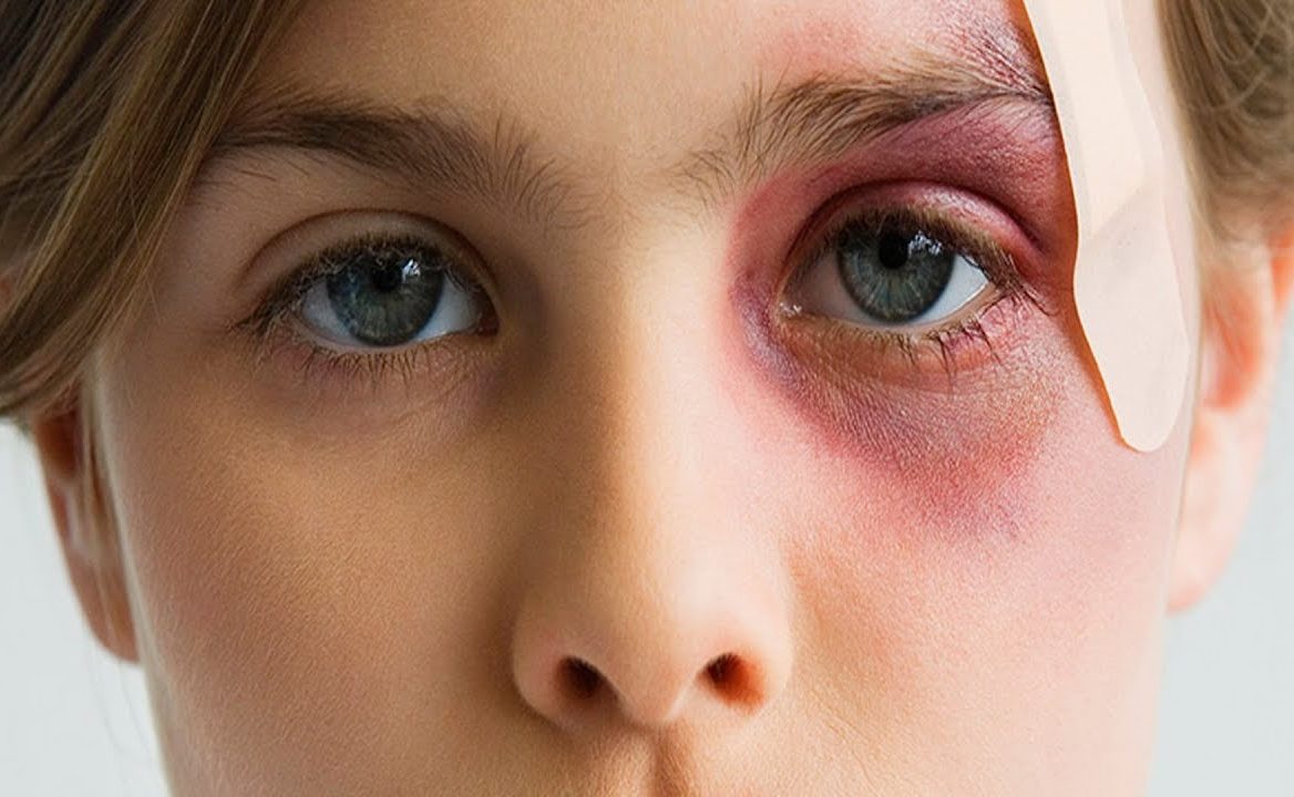Как долго проходит синяк под глазом - через какое время он исчезает