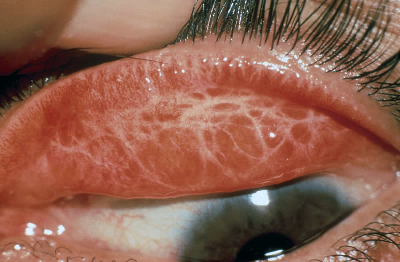 Что такое трахома глаз