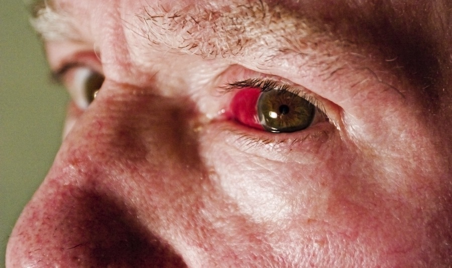 Как лечить кровоизлияние в глазу