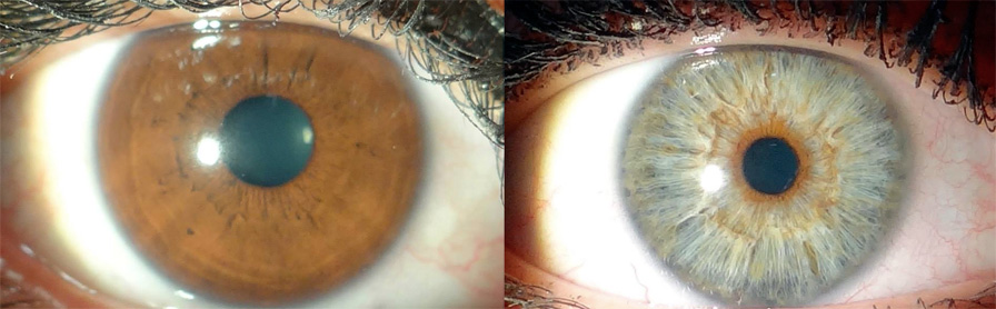 Изменение цвета глаз лазером