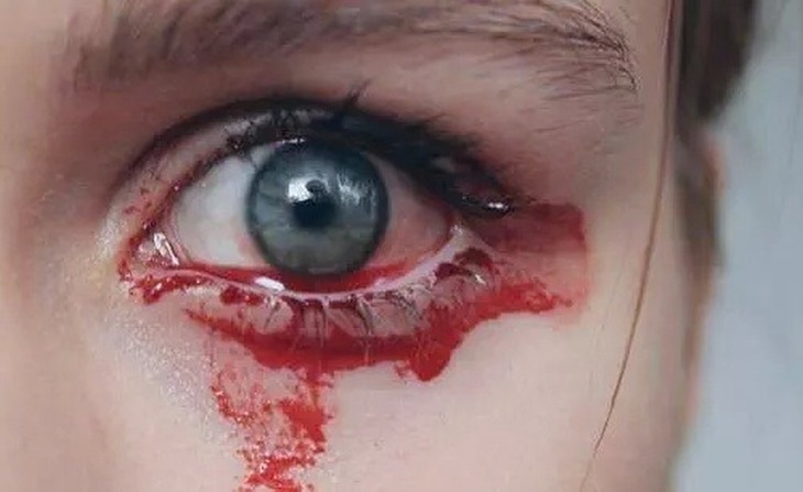 Почему идет кровь из глаз