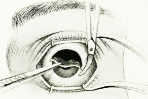 enukleatsiya-glaznogo-yabloka