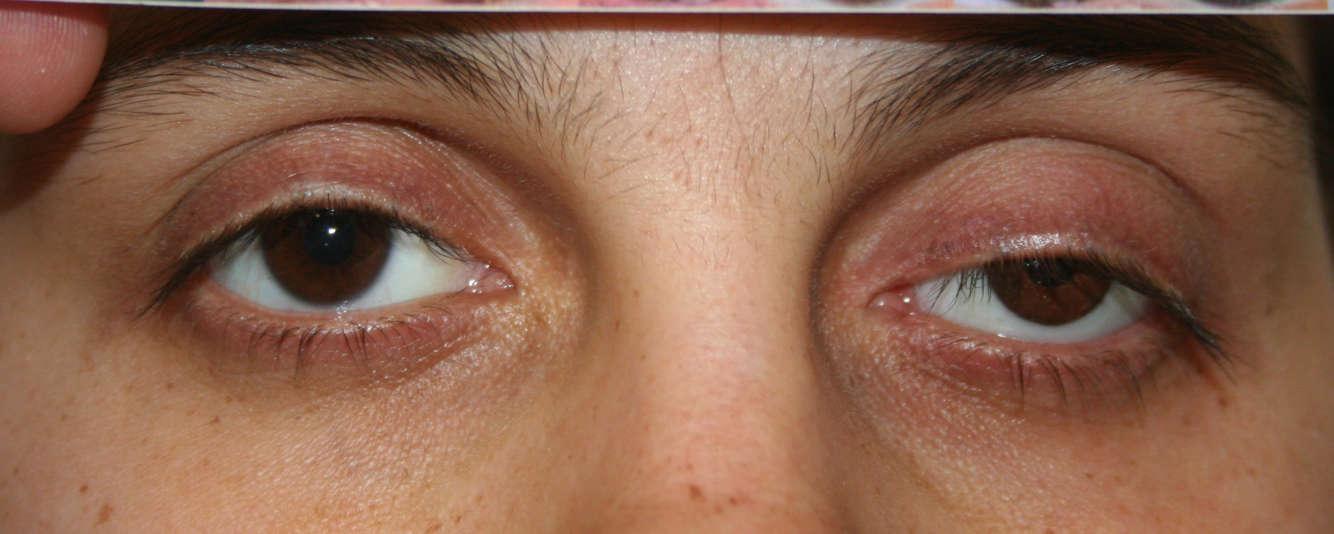 Список заболеваний глаз у человека - описание симптомов