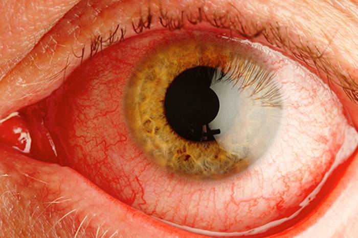 Список заболеваний глаз у человека - описание симптомов