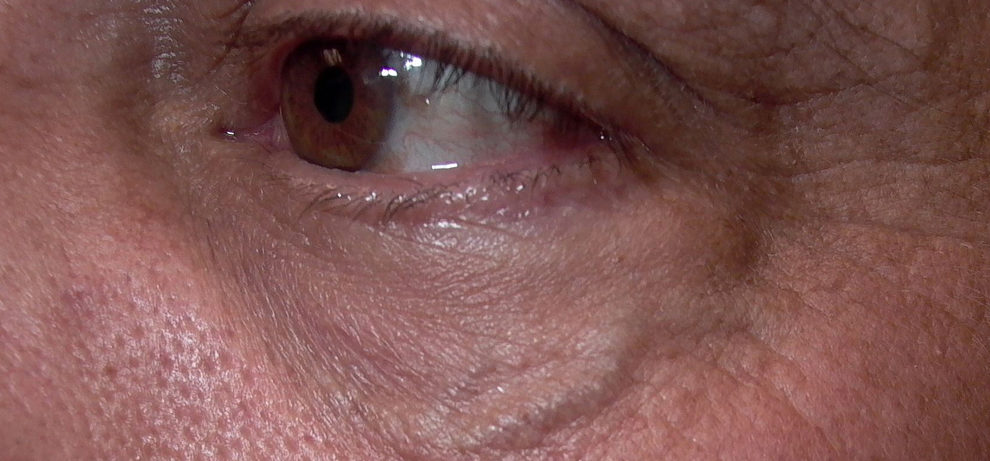 Как избавиться от вен под глазами