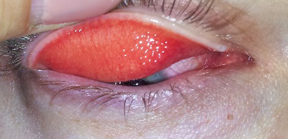 Фолликулярный конъюнктивит