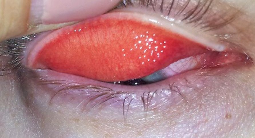 Хламидийный конъюнктивит - фото, симптомы и лечение