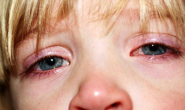 блефарит у детей
