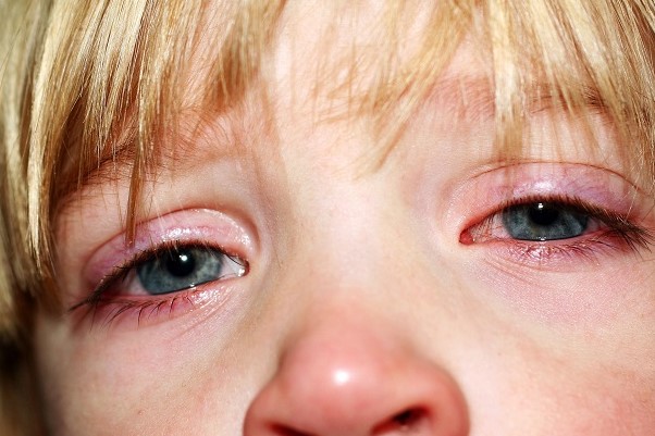 блефарит у детей