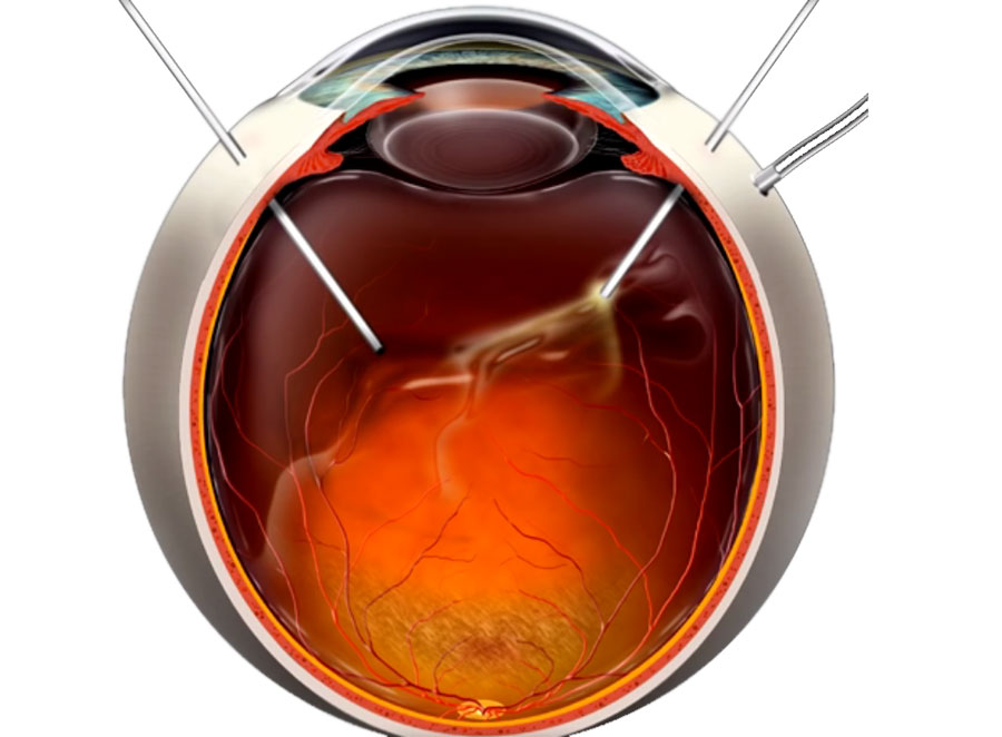 Витрэктомия