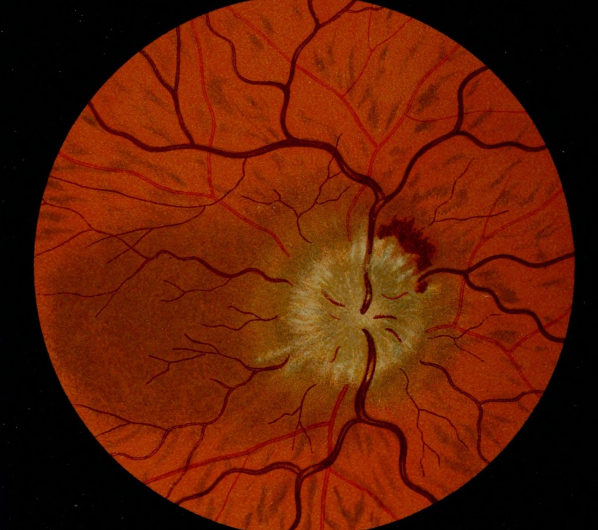 Неврит (воспаление) зрительного нерва