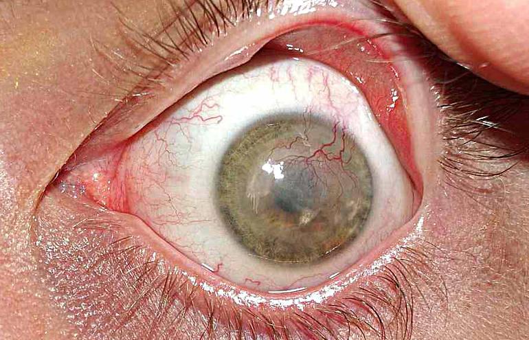 Зрение минус 8