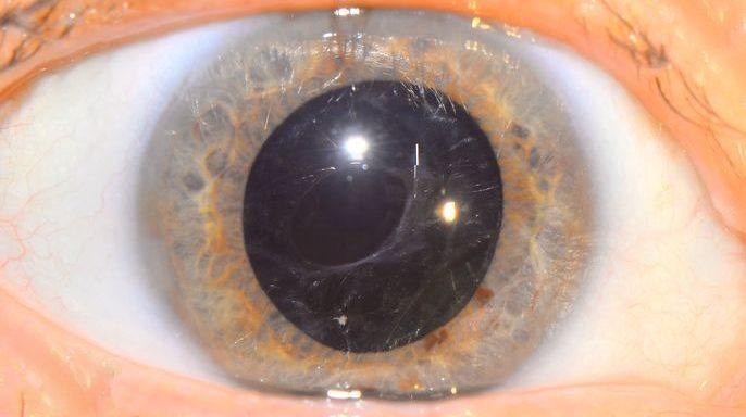 Начальная катаракта