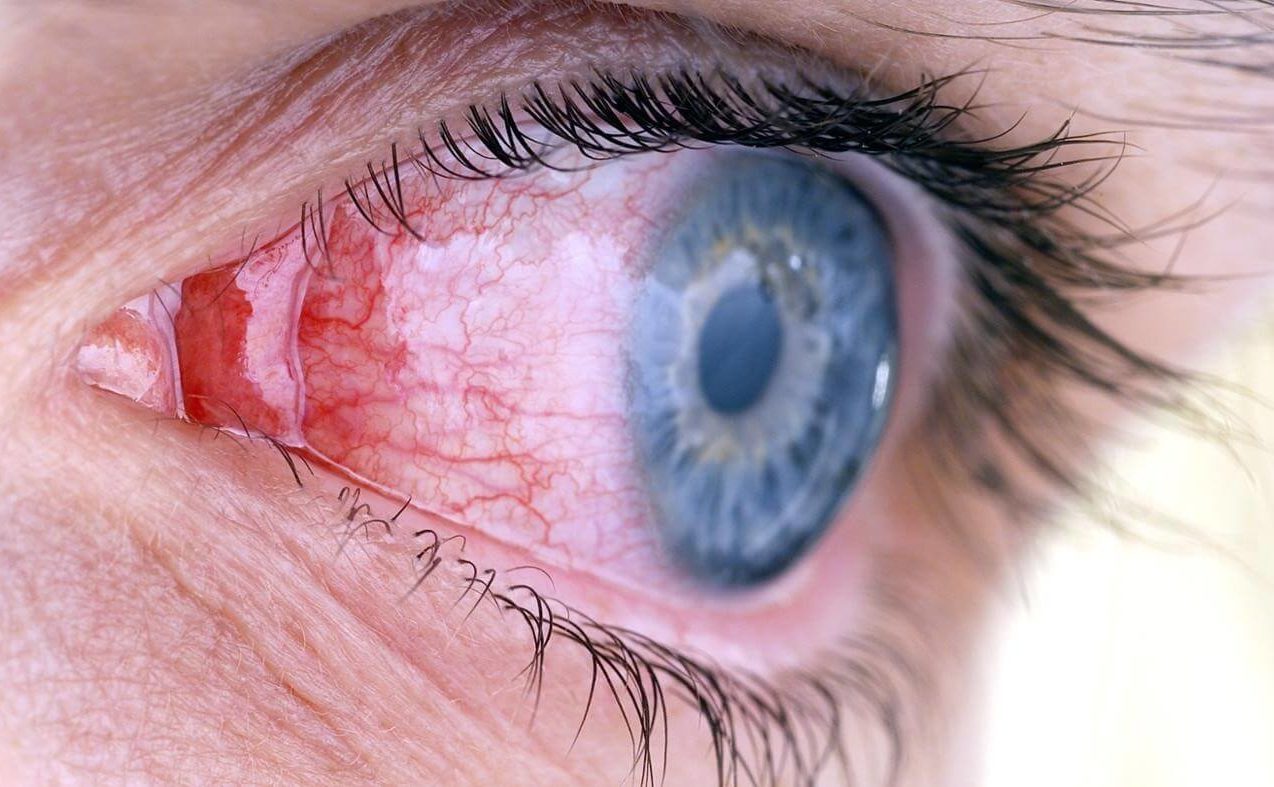 Инъекция сосудов склер