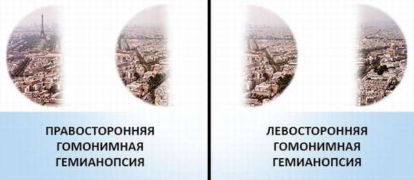 Гомонимная гемианопсия