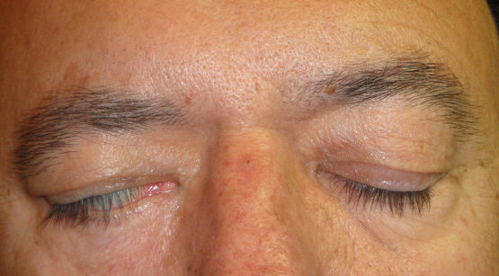 Лагофтальм или несмыкание век