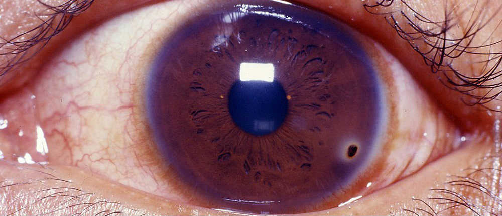 Как достать окалину из глаза