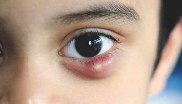 Чирей на глазу у ребенка
