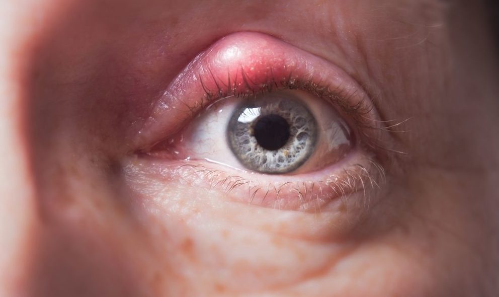 Если ячмень не проходит