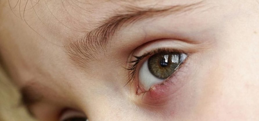 Что такое ячмень