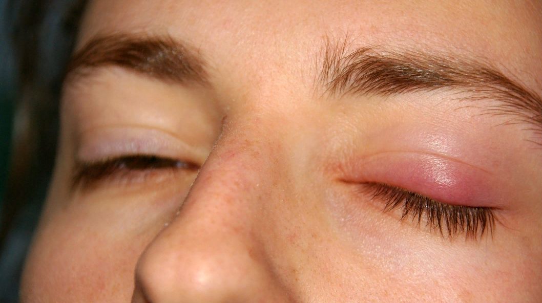 Определение вида заболевания